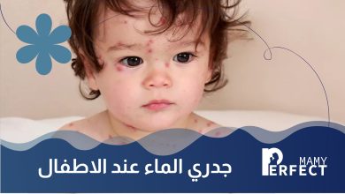جدري الماء عند الاطفال