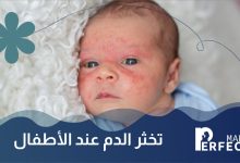 تخثر الدم عند الأطفال