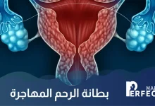 بطانة الرحم المهاجرة