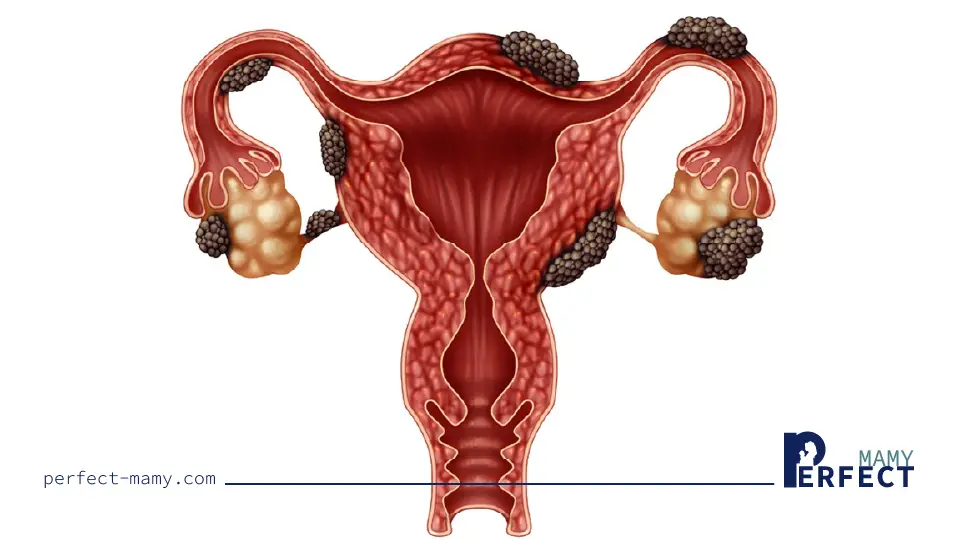 أعراض بطانات الرحم المهاجرة
