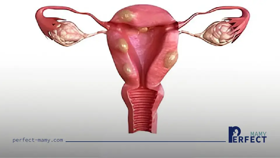 تأثير بطانات الرحم المهاجرة على الخصوبة