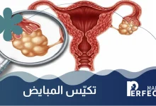 تكييس المبايض