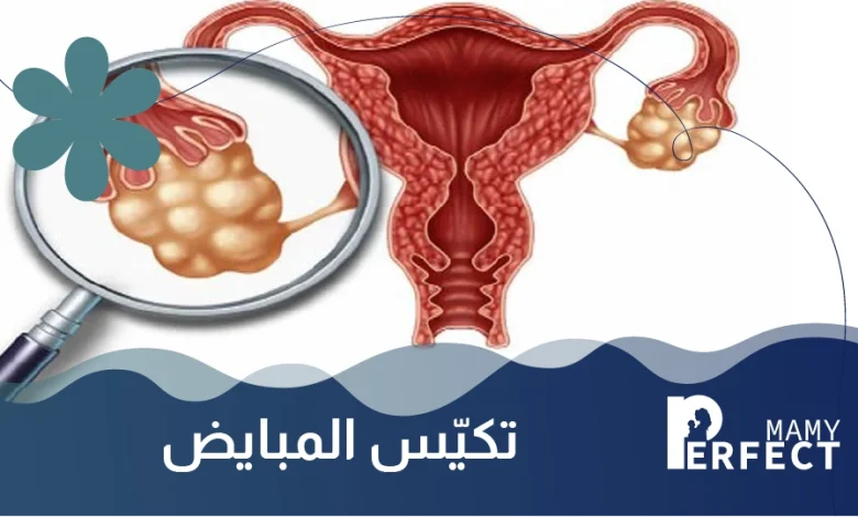 تكييس المبايض