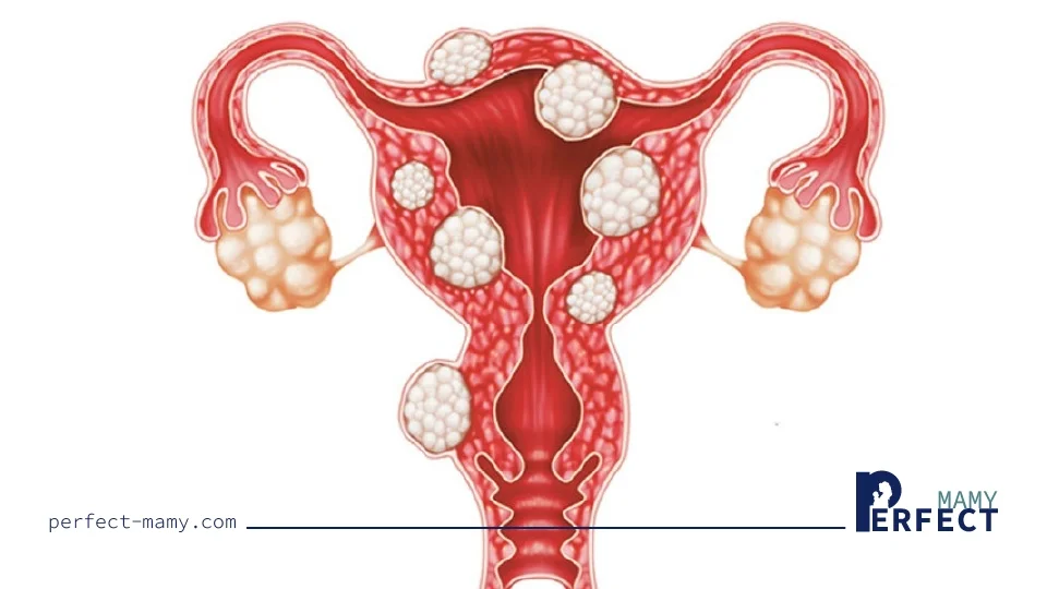علاج تكييس المبايض