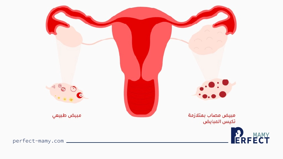 متلازمة تكيس المبايض