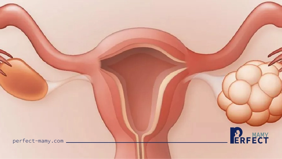 تكيسات المبايض